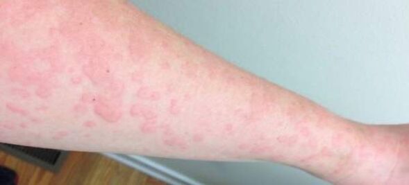 Cilt alerjileri vücutta parazit varlığının bir işaretidir